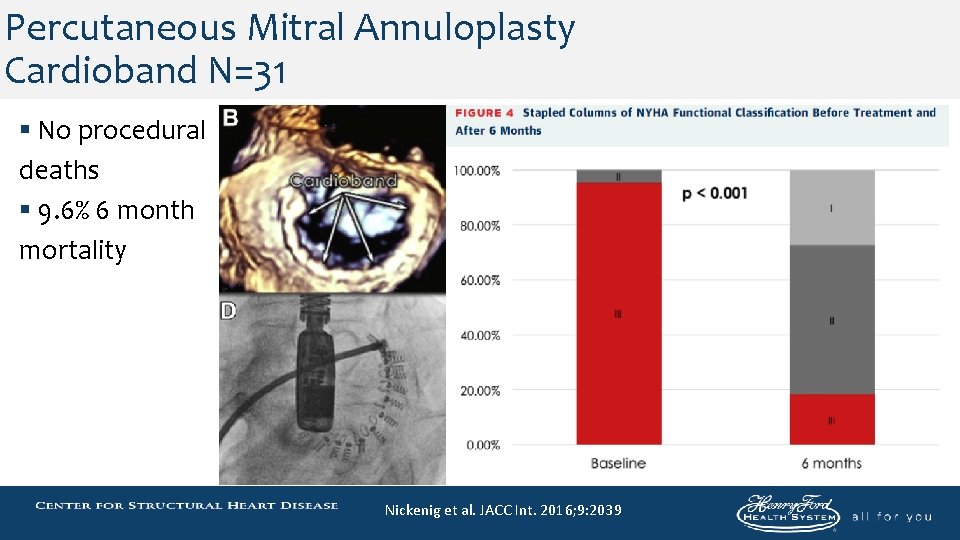 Percutaneous Mitral Annuloplasty Cardioband N=31 § No procedural deaths § 9. 6% 6 month