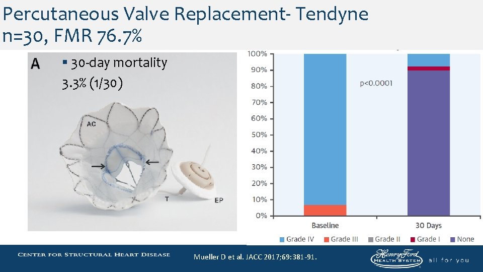 Percutaneous Valve Replacement- Tendyne n=30, FMR 76. 7% § 30 -day mortality 3. 3%
