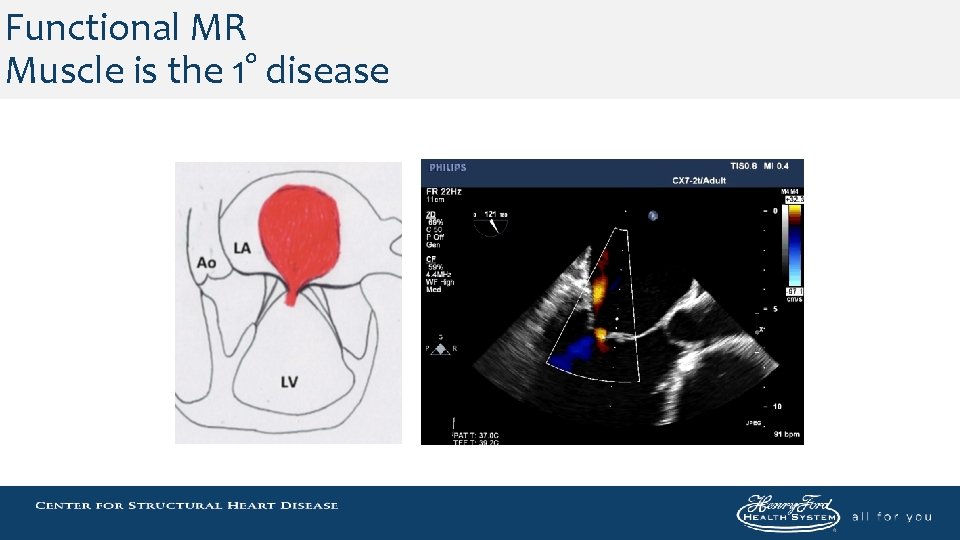 Functional MR Muscle is the 1° disease 
