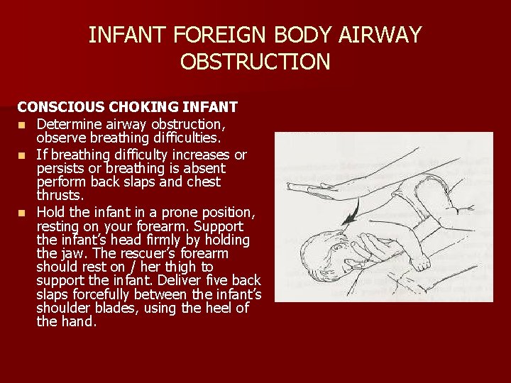 INFANT FOREIGN BODY AIRWAY OBSTRUCTION CONSCIOUS CHOKING INFANT n Determine airway obstruction, observe breathing