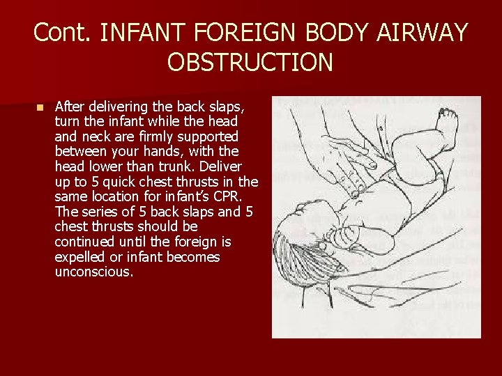 Cont. INFANT FOREIGN BODY AIRWAY OBSTRUCTION n After delivering the back slaps, turn the