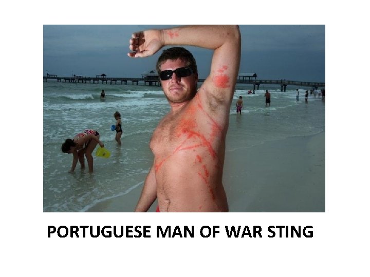 PORTUGUESE MAN OF WAR STING 