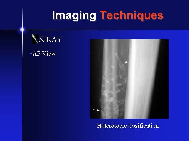 Imaging Techniques X-RAY • AP View Heterotopic Ossification 