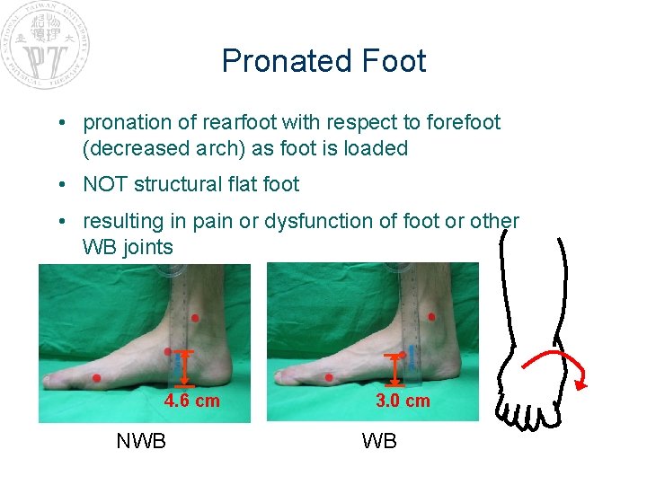 Pronated Foot • pronation of rearfoot with respect to forefoot (decreased arch) as foot