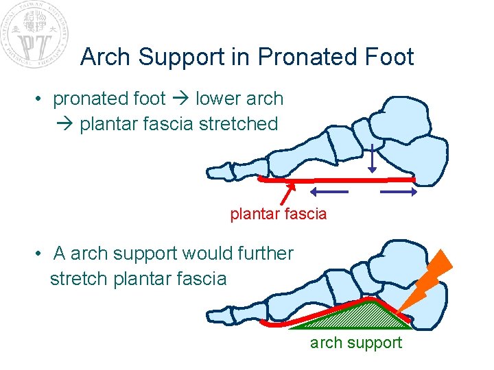 Arch Support in Pronated Foot • pronated foot lower arch plantar fascia stretched plantar