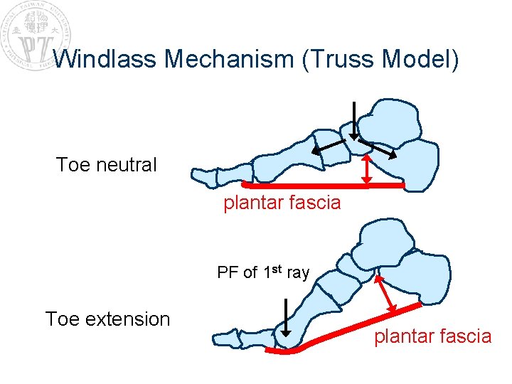 Windlass Mechanism (Truss Model) Toe neutral plantar fascia PF of 1 st ray Toe