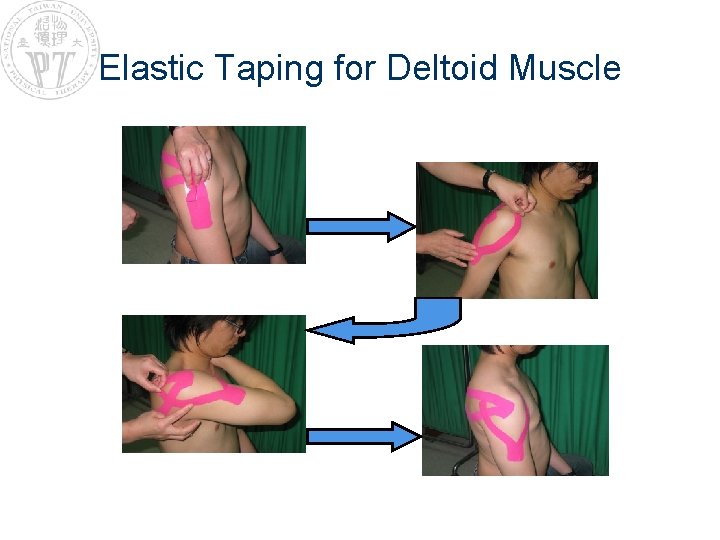 Elastic Taping for Deltoid Muscle 