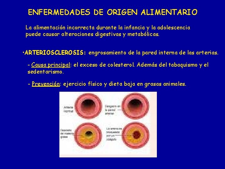 ENFERMEDADES DE ORIGEN ALIMENTARIO La alimentación incorrecta durante la infancia y la adolescencia puede ENFERMEDADES DE ORIGEN ALIMENTARIO La alimentación incorrecta durante la infancia y la adolescencia puede
