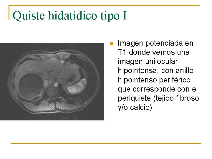 Quiste hidatídico tipo I n Imagen potenciada en T 1 donde vemos una imagen