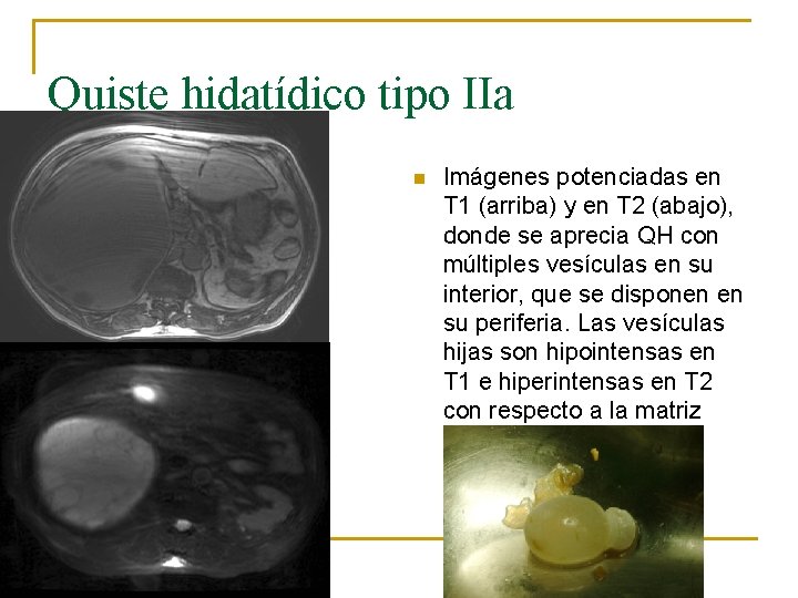 Quiste hidatídico tipo IIa n Imágenes potenciadas en T 1 (arriba) y en T