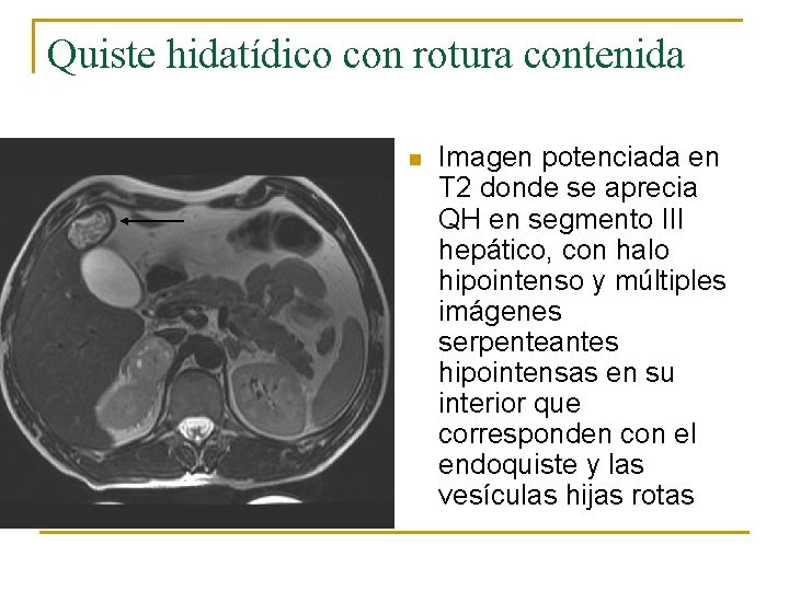 Quiste hidatídico con rotura contenida n Imagen potenciada en T 2 donde se aprecia