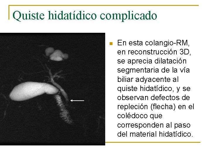 Quiste hidatídico complicado n En esta colangio-RM, en reconstrucción 3 D, se aprecia dilatación