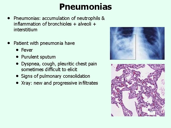 Pneumonias • Pneumonias: accumulation of neutrophils & inflammation of bronchioles + alveoli + interstitium Pneumonias • Pneumonias: accumulation of neutrophils & inflammation of bronchioles + alveoli + interstitium