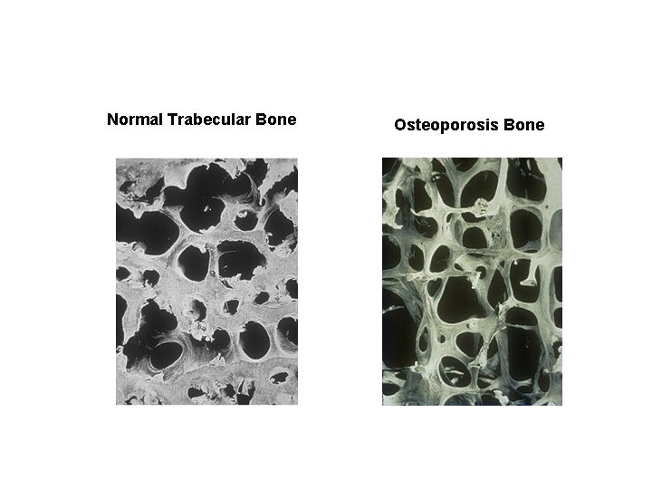 Normal Trabecular Bone Osteoporosis Bone 