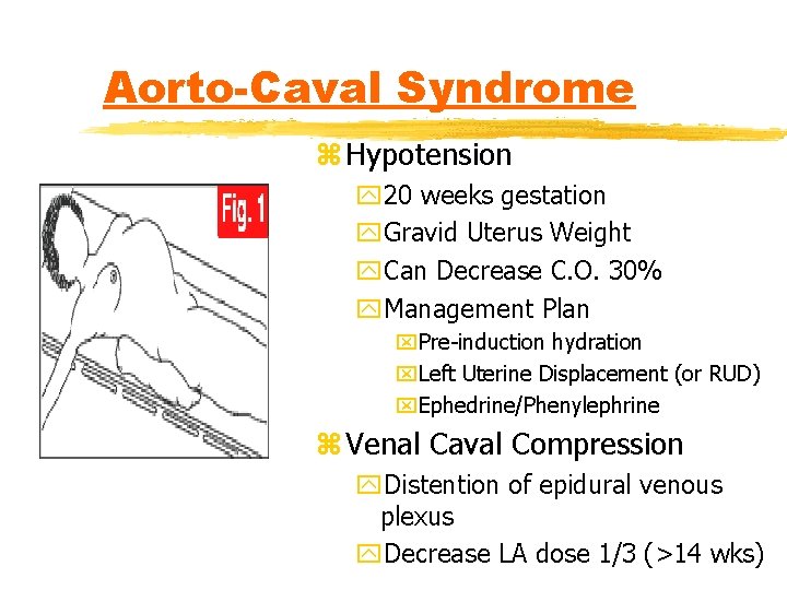 Aorto-Caval Syndrome z Hypotension y 20 weeks gestation y. Gravid Uterus Weight y. Can