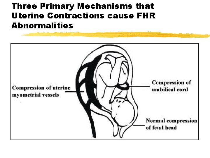 Three Primary Mechanisms that Uterine Contractions cause FHR Abnormalities 