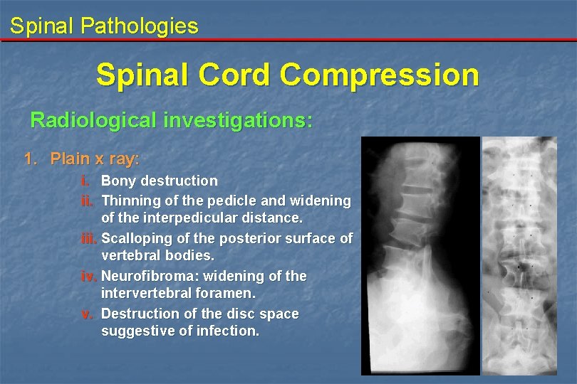 Spinal Pathologies Spinal Cord Compression Radiological investigations: 1. Plain x ray: i. Bony destruction