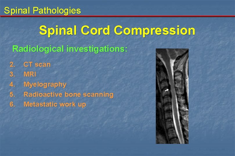 Spinal Pathologies Spinal Cord Compression Radiological investigations: 2. 3. 4. 5. 6. CT scan