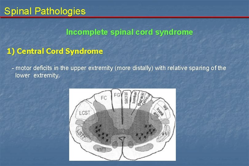 Spinal Pathologies Incomplete spinal cord syndrome 1) Central Cord Syndrome - motor deficits in