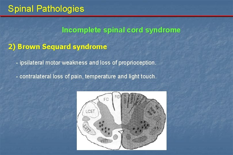 Spinal Pathologies Incomplete spinal cord syndrome 2) Brown Sequard syndrome - ipsilateral motor weakness