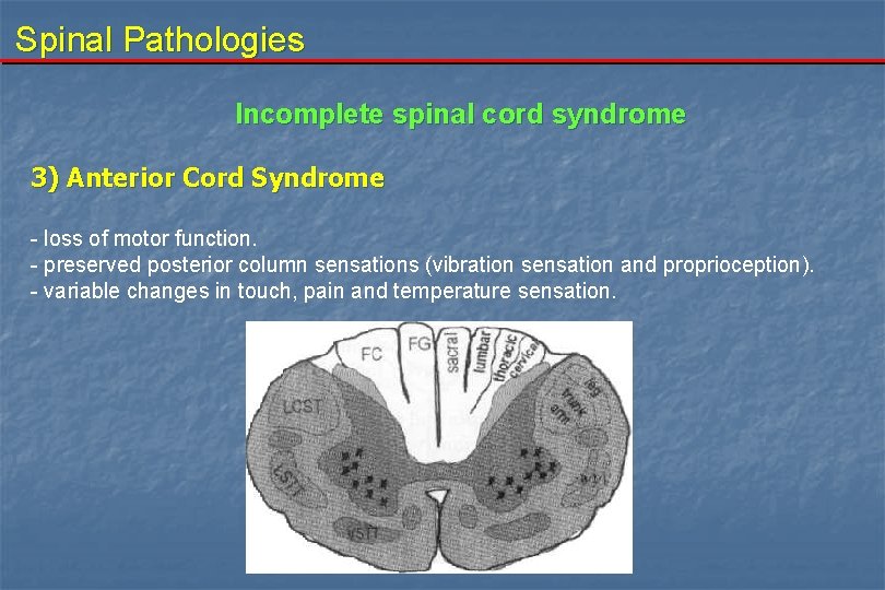 Spinal Pathologies Incomplete spinal cord syndrome 3) Anterior Cord Syndrome - loss of motor