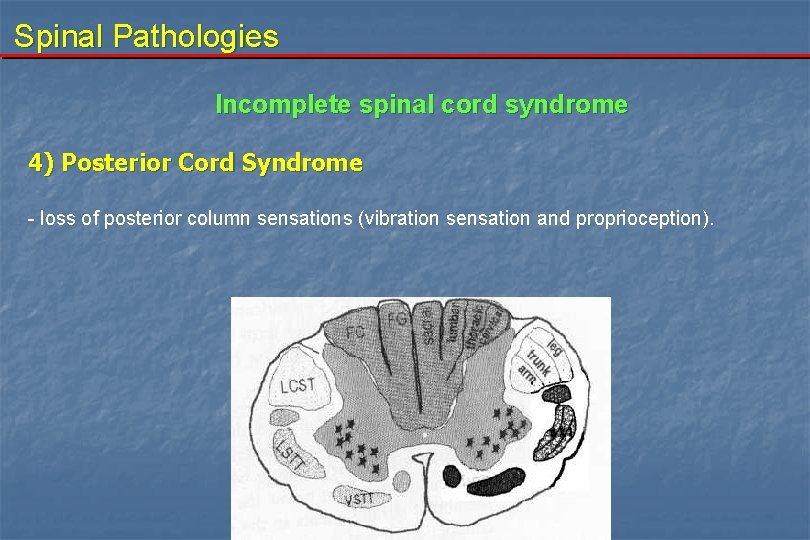 Spinal Pathologies Incomplete spinal cord syndrome 4) Posterior Cord Syndrome - loss of posterior