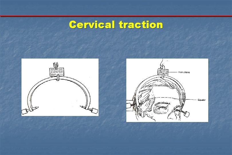 Cervical traction 