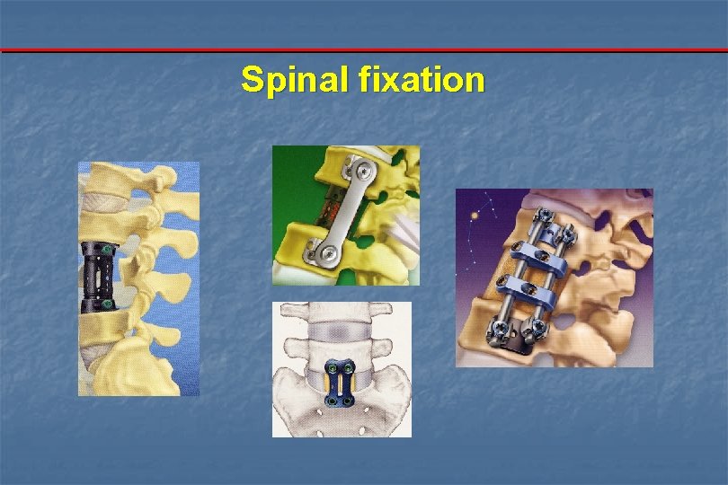 Spinal fixation 