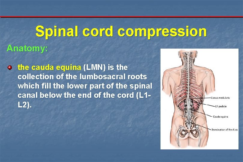 Spinal cord compression Anatomy: the cauda equina (LMN) is the collection of the lumbosacral