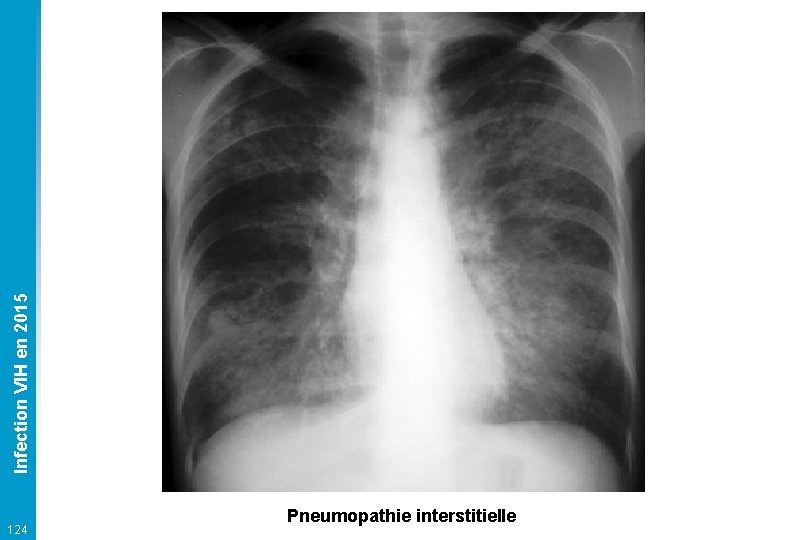 Infection VIH en 2015 124 Pneumopathie interstitielle 