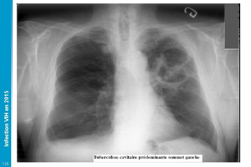 126 Infection VIH en 2015 