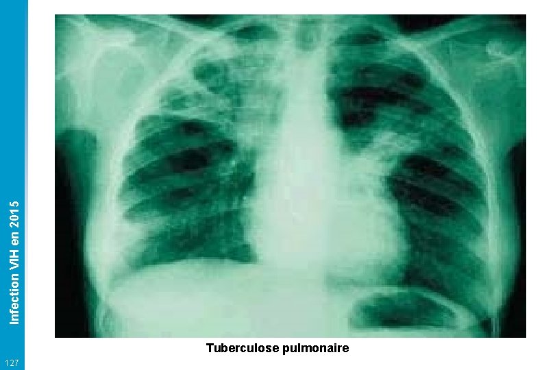 Infection VIH en 2015 Tuberculose pulmonaire 127 