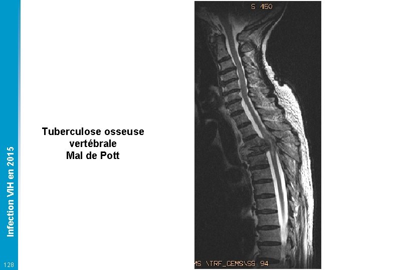 Infection VIH en 2015 128 Tuberculose osseuse vertébrale Mal de Pott 