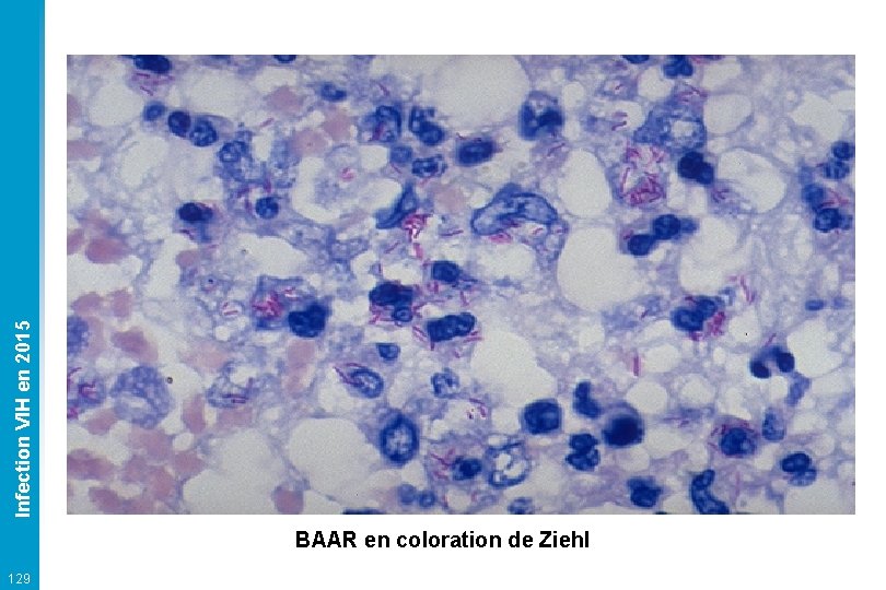 Infection VIH en 2015 BAAR en coloration de Ziehl 129 