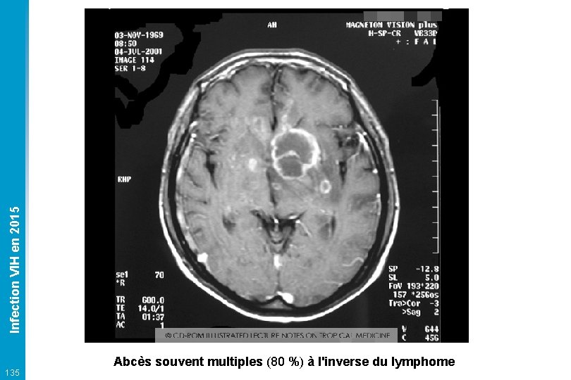 Infection VIH en 2015 135 Abcès souvent multiples (80 %) à l'inverse du lymphome