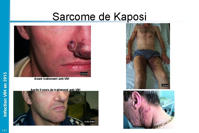 Infection VIH en 2015 Sarcome de Kaposi 147 Avant traitement anti-VIH Après 9 mois