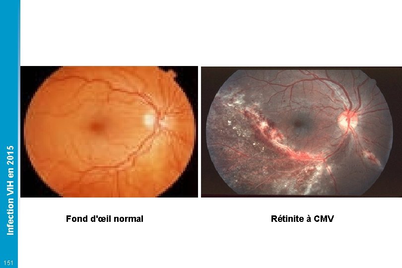 Infection VIH en 2015 151 Fond d'œil normal Rétinite à CMV 