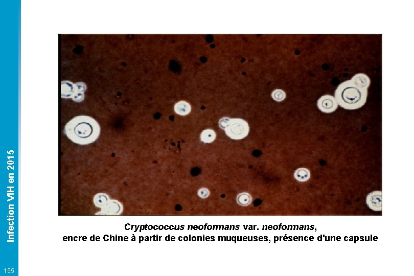 Infection VIH en 2015 155 Cryptococcus neoformans var. neoformans, encre de Chine à partir