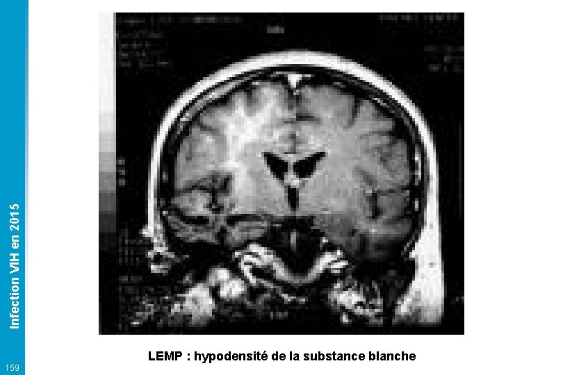 Infection VIH en 2015 LEMP : hypodensité de la substance blanche 159 