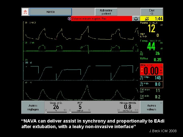 “NAVA can deliver assist in synchrony and proportionally to EAdi after extubation, with a