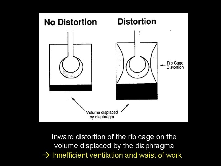 Inward distortion of the rib cage on the volume displaced by the diaphragma Innefficient