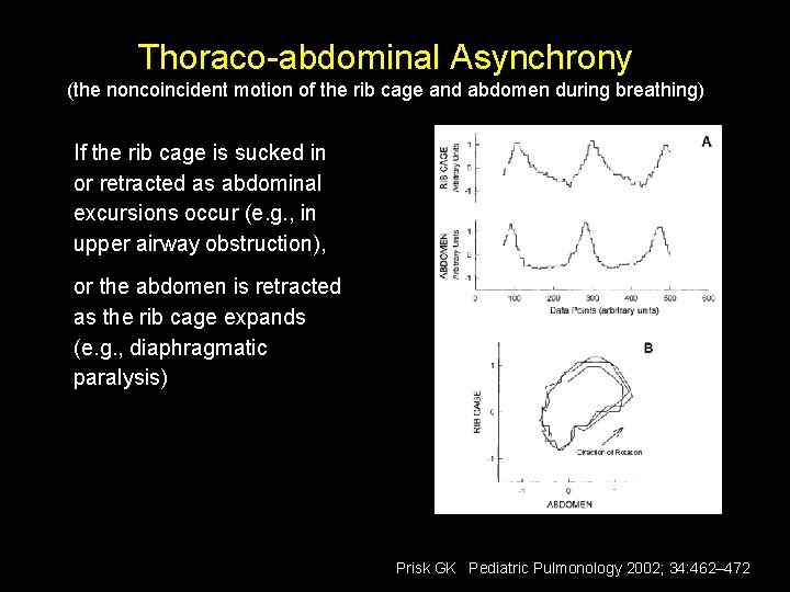 Thoraco-abdominal Asynchrony (the noncoincident motion of the rib cage and abdomen during breathing) If