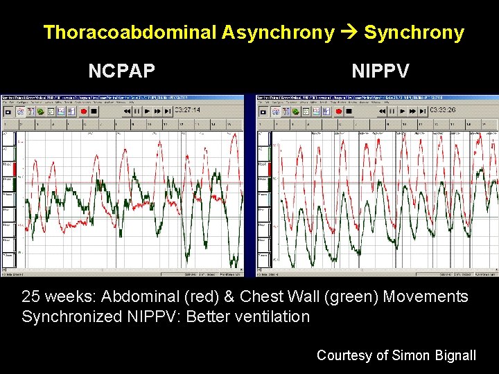 Thoracoabdominal Asynchrony Synchrony NCPAP NIPPV 25 weeks: Abdominal (red) & Chest Wall (green) Movements