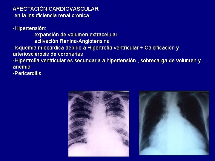 AFECTACIÓN CARDIOVASCULAR en la insuficiencia renal crónica -Hipertensión: expansión de volumen extracelular activación Renina-Angiotensina AFECTACIÓN CARDIOVASCULAR en la insuficiencia renal crónica -Hipertensión: expansión de volumen extracelular activación Renina-Angiotensina