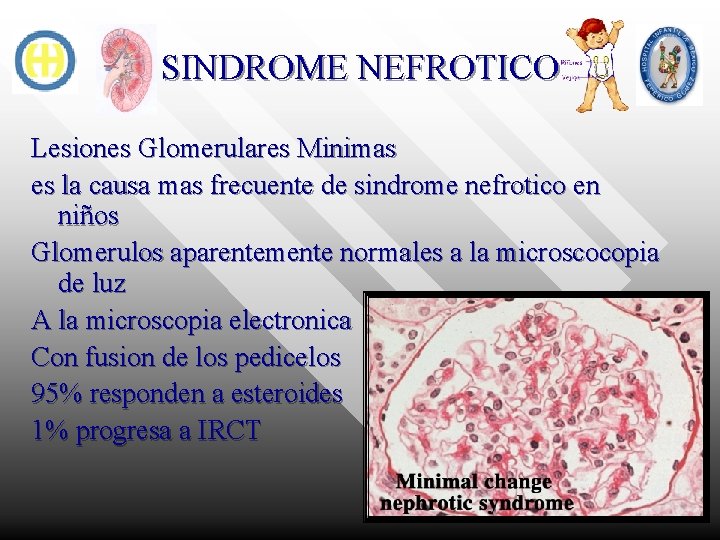 SINDROME NEFROTICO Lesiones Glomerulares Minimas es la causa mas frecuente de sindrome nefrotico en