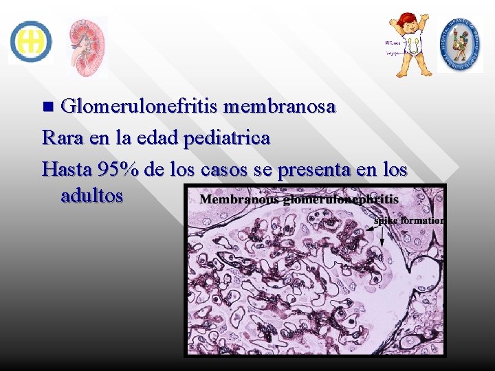 Glomerulonefritis membranosa Rara en la edad pediatrica Hasta 95% de los casos se presenta