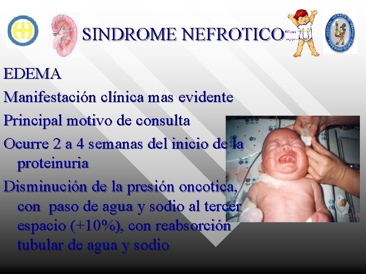 SINDROME NEFROTICO EDEMA Manifestación clínica mas evidente Principal motivo de consulta Ocurre 2 a