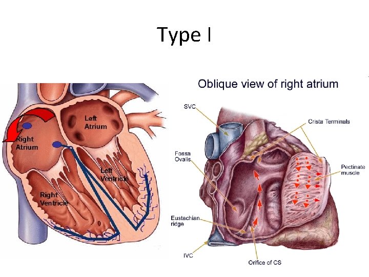 Type I 