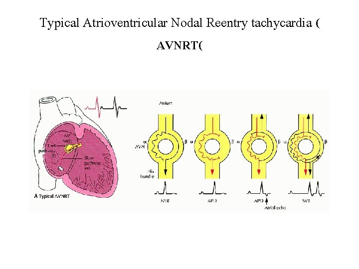 Typical Atrioventricular Nodal Reentry tachycardia ( AVNRT( 