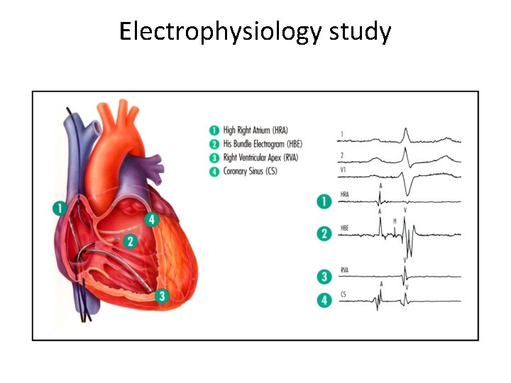 Electrophysiology study 